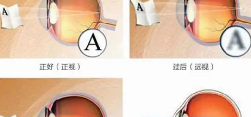 如何预防儿童屈光不正