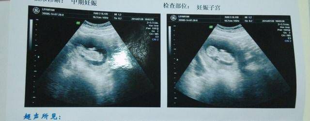 怀孕了，怎样科学判断孩子是男是女？