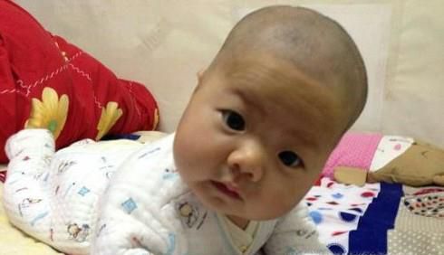 如何预防小儿方颅？
