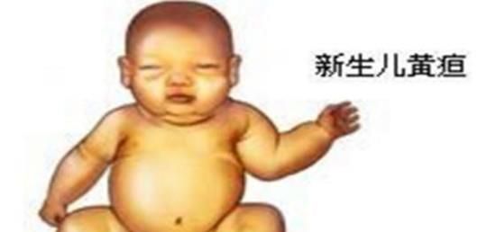 婴儿黄疸应该怎样处理