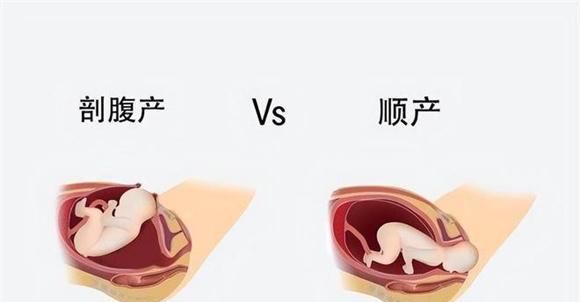 顺产还是剖宫产  没有哪个更轻松 带你一起了解下