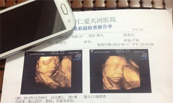 四维彩超的宝宝图片和生下宝宝的相貌有何区别