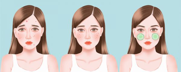 怎么去除黑头和毛孔粗大 黑头和毛孔粗大的原因