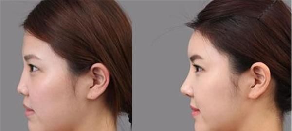 常见的鼻子变高的方法有什么