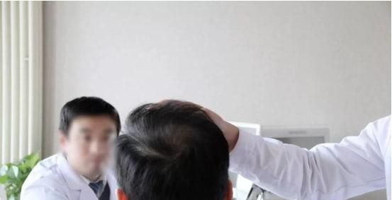 前额脱发还能恢复吗