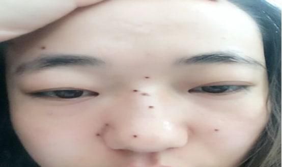 去痣多久可以洗脸