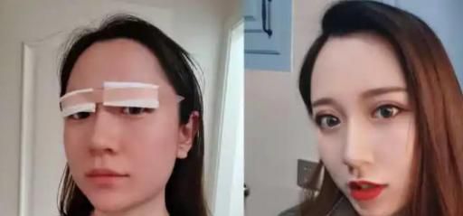 割双眼皮恢复期应该注意什么？