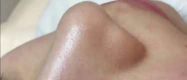 如何自己去黑头