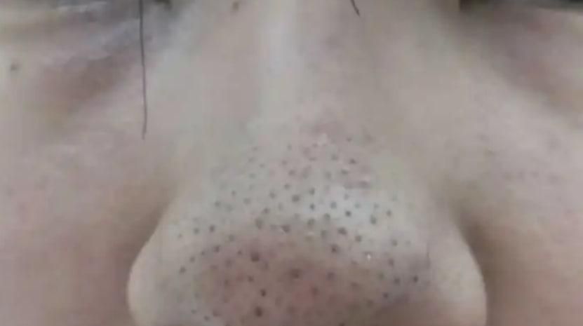 如何去鼻子上的黑头最有效方法