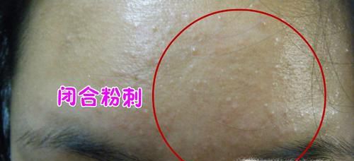 6个导致你长闭口粉刺的原因