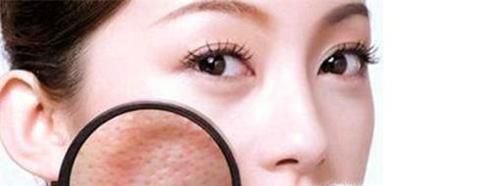 鼻头脸颊毛孔粗大、有白头黑头要怎么办