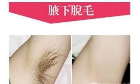 怎样去除腋下毛发