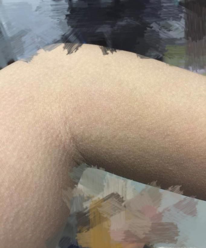 鱼鳞病的原因及护理
