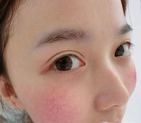 针对面部红血丝的民间小偏方
