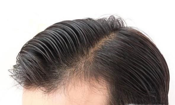 种发际线多少钱