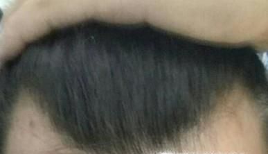 发际线是天生的吗？发际线怎么调整？