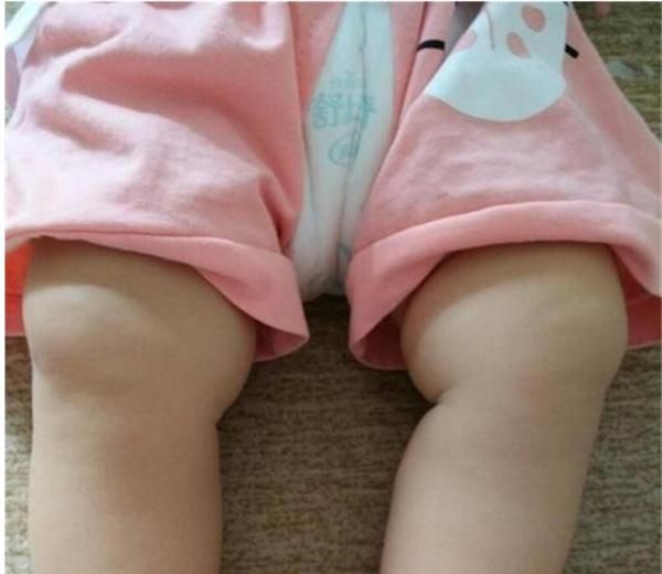 孩子长期睡觉绑腿腿能直吗