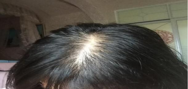 女性头发少吃什么维生素