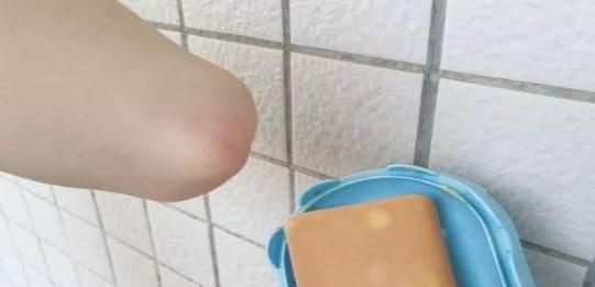 被蚊子咬了怎么处理