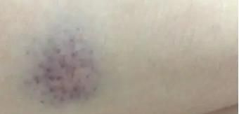 身上无缘无故出现淤青是什么原因