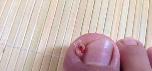 指甲长到肉里怎么办