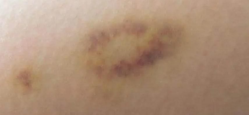 身上总是青一块紫一块什么原因