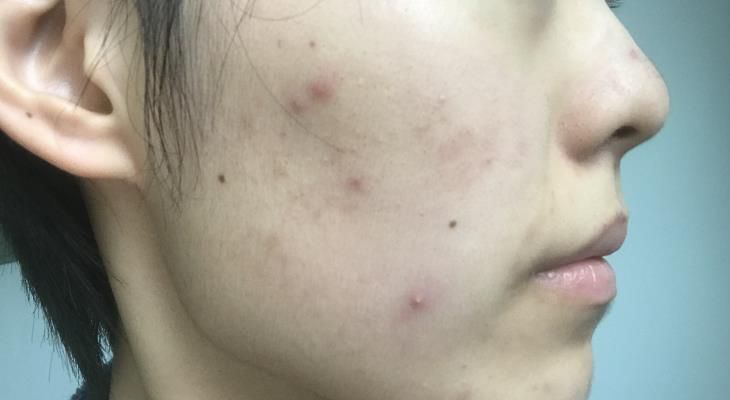 脸上出现了不少粉刺，该怎么办？