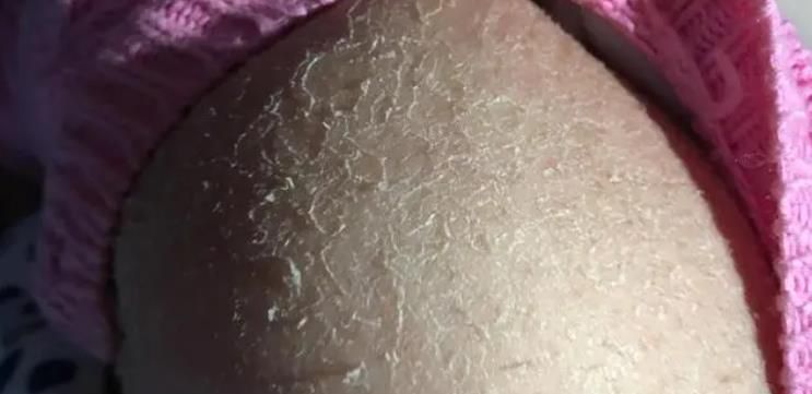 皮肤出现干燥是什么原因？