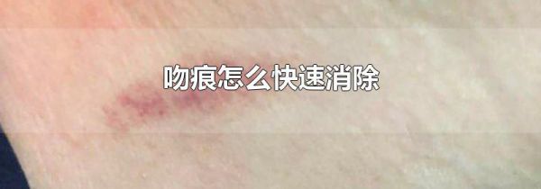 吻痕怎么快速消除