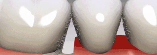 牙垢的危害