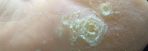 鸡眼是怎么形成的