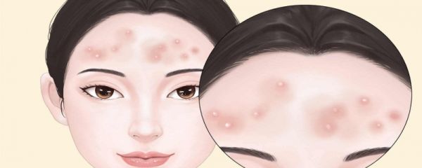 过敏在家如何快速处理 具体方法有哪些