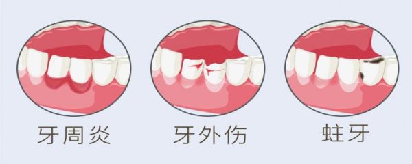 种牙大概多少钱一颗 能维持几年