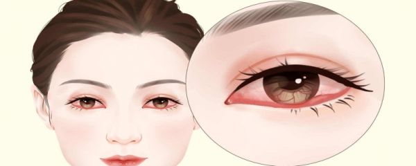 新冠后红眼病能治好吗 新冠眼睛红怎么治疗