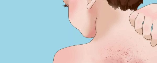 孩子过敏怎么查过敏原因 需要注意什么